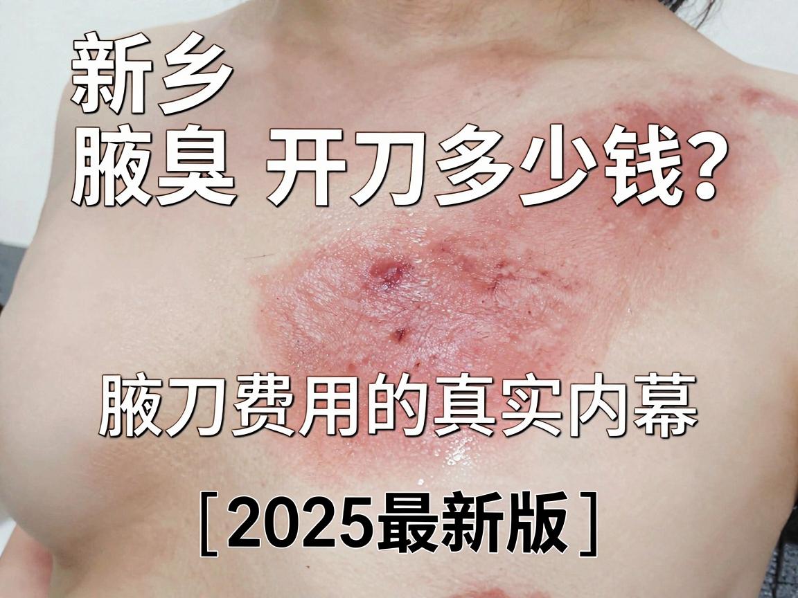 新乡腋臭开刀多少钱？一篇说清腋臭开刀费用的真实内幕（2025最新版）