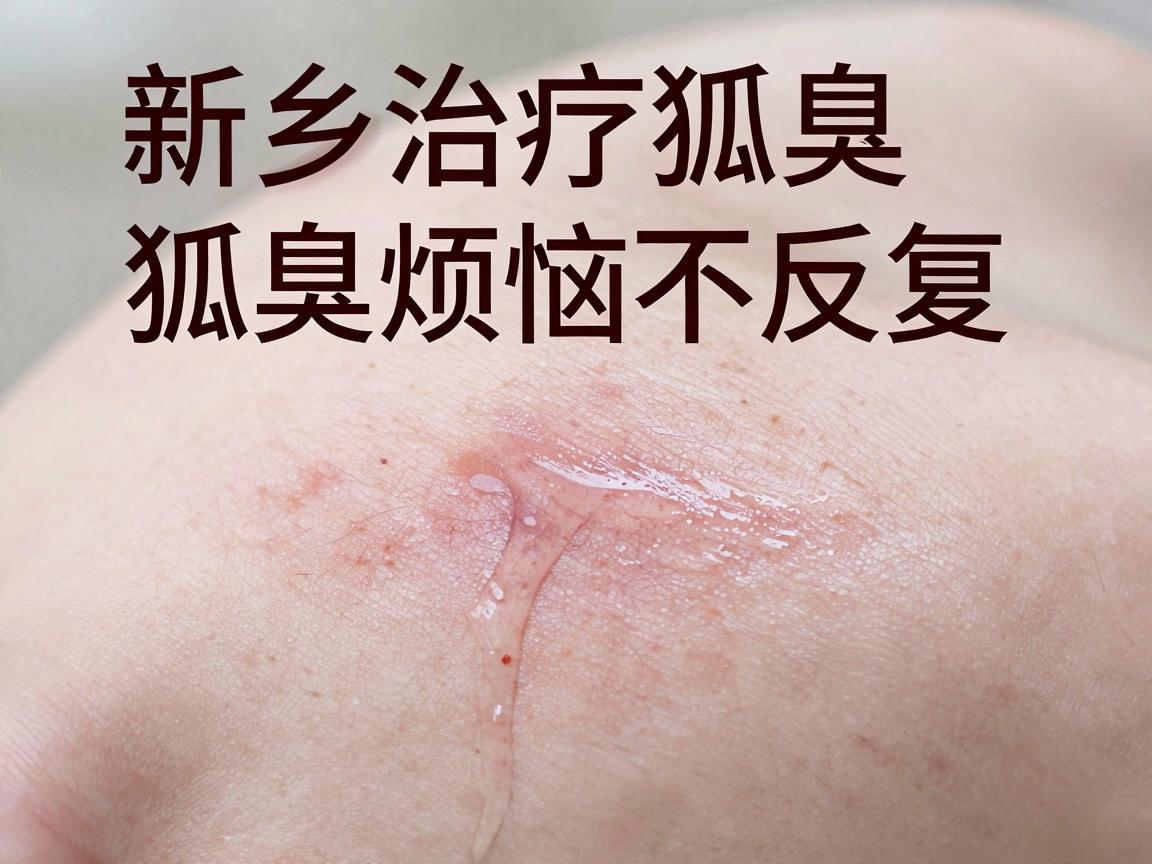 新乡治疗狐臭专科，狐臭烦恼不反复，新乡专科有良方