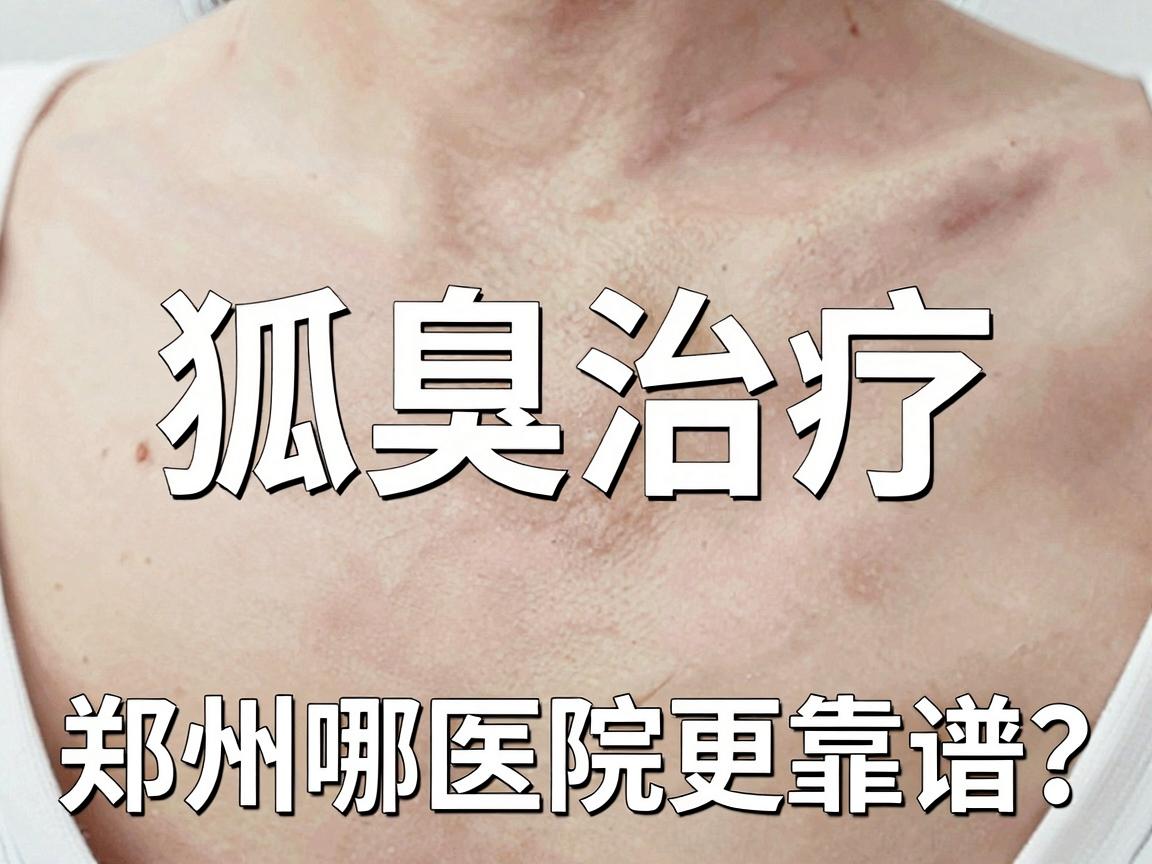 郑州治疗狐臭哪家医院专业？揭秘狐臭治疗，郑州哪家医院更靠谱？